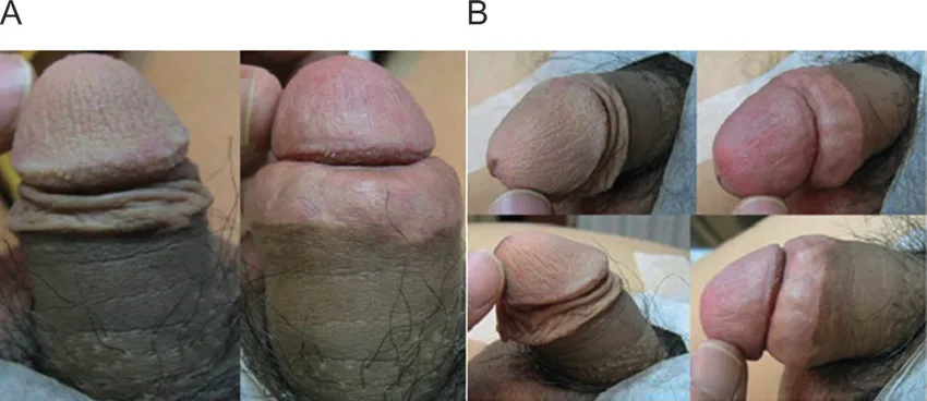 Fig 5. Comparativa pre y post a 18 meses, con aumento simultáneo de glande